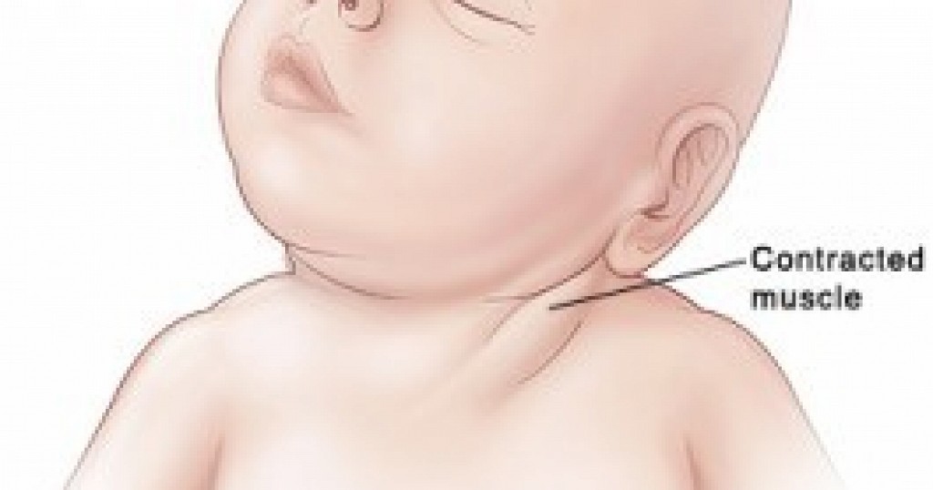 Therapy for torticollis in babies