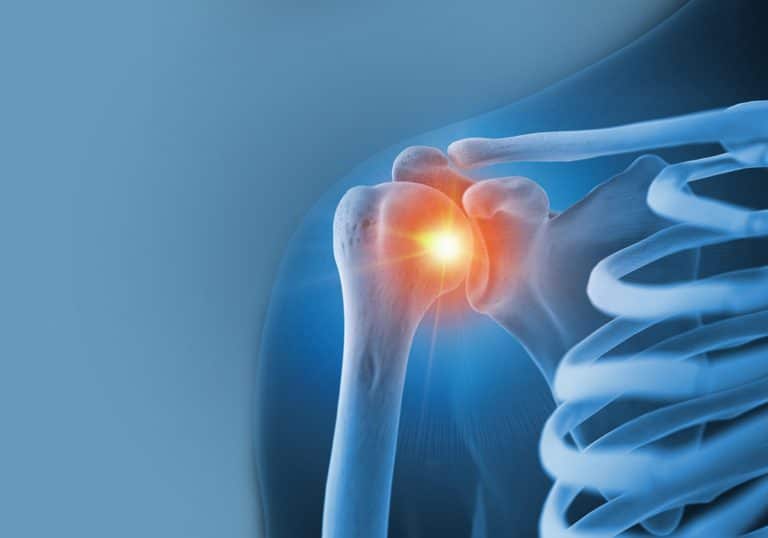 Total Joint Shoulder Surgery Recovery